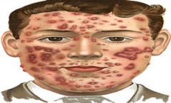 Overview of Cystic Acne Causes and Treatments