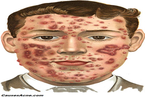 Cystic Acne