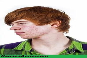 Teen Acne Causes and Treatments