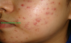 Which Type of Acne Scar Do You Have?