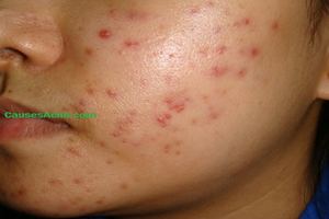 Acne Scar