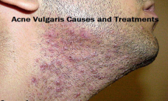Acne Vulgaris Causes and Treatments
