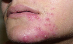 Acne Rosacea – More Than Just A Nuisance