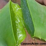 Aloe Vera for acne