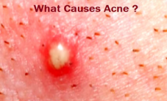 Adult Acne Causes and Treatments