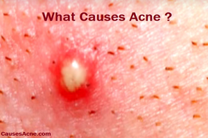 Causes acne