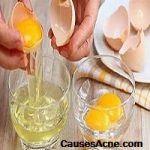 Egg White Mask for acne