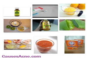 Natural Home Remedies To Treat Acne