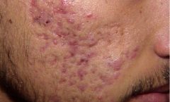 Treating acne is not that difficult.