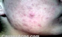 Acne treatment and the reasons for its increase