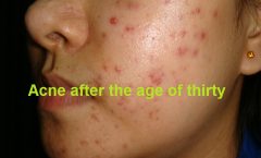 Acne in Women Over 30: Causes and Treatment