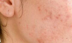 what does hormonal acne look like
